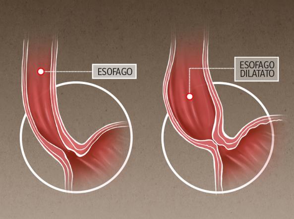 Acalasia, video dell'intervento di miotomia sec. Heller e plastica antireflusso sec. Dor